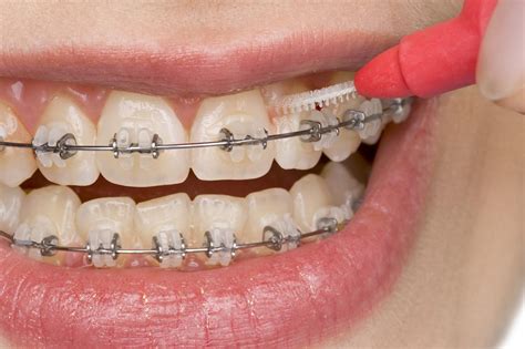 Types of Braces in Goddard, Hutchinson & Wichita | Hansen Orthodontics