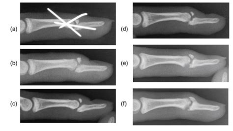 Conservative Treatment of Chronic Mallet Fracture Non-union after ...