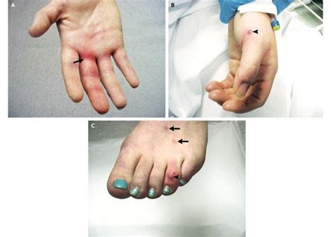 Disseminated Gonococcal Infection: Causes and Symptoms