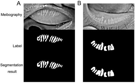 A Deep Learning Model for Evaluating Meibomian Glands Morphology from Meibography