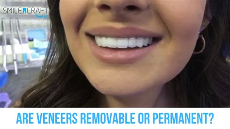 Are Veneers Removable or Permanent?