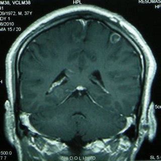 (PDF) Diagnosis and Treatment of Neurocysticercosis