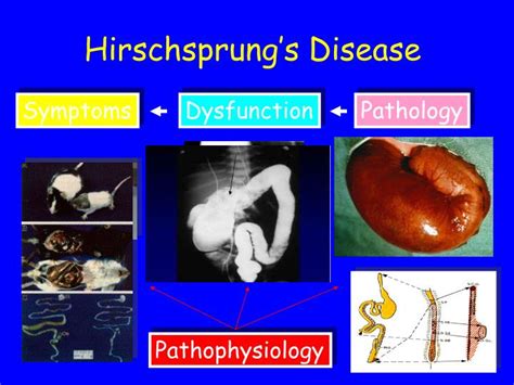 PPT - “Functional” Bowel Disorders PowerPoint Presentation - ID:3763661