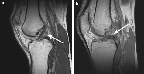 Mri Scan Knee Ligament Damage