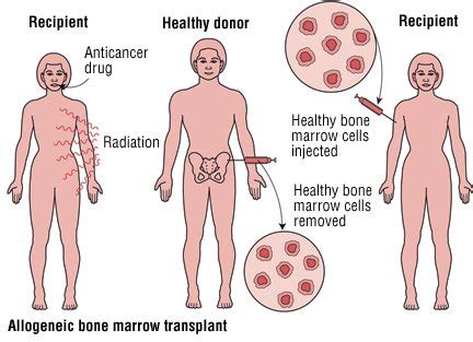 Bone Marrow Transplant Guide