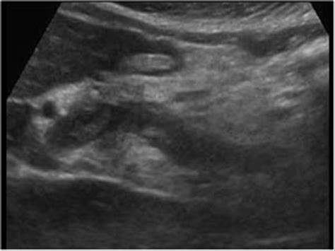 Abdomen and retroperitoneum | 1.7 Peritoneum mesentery and omentum ...