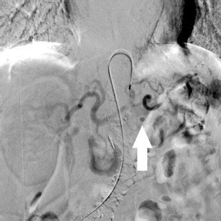 Celiac trunk angiography. A nodular enhancing lesion suggesting... | Download Scientific Diagram