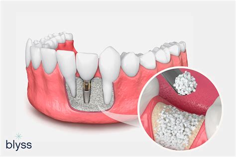 Bone graft surgery dental - Peridot Dental Care