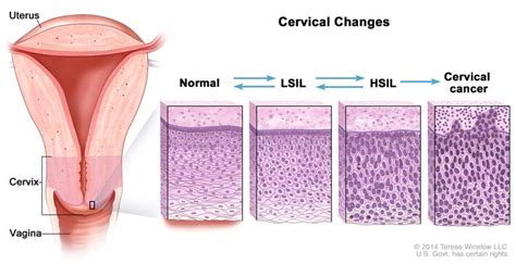 HPV and Pap Test Results: Next Steps after an Abnormal Test - NCI