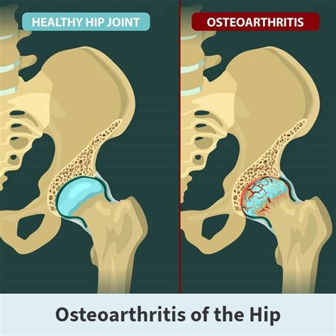 Treatment For Hip Out Of Place at Jason Lambert blog