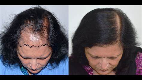 Female Hair Transplant at Medispa | Jaipur | Delhi | USA | UK | Dr Suneet Soni - YouTube