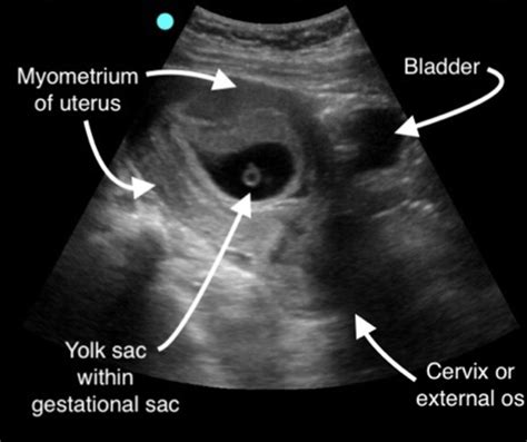 Ultrasound First Trimester Of Pregnancy