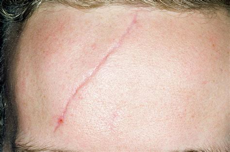 Scar On The Forehead Photograph by Dr P. Marazzi/science Photo Library