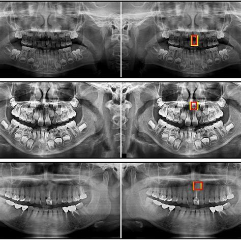 The oral radiologist annotated the mesiodens with a yellow rectangular... | Download Scientific ...