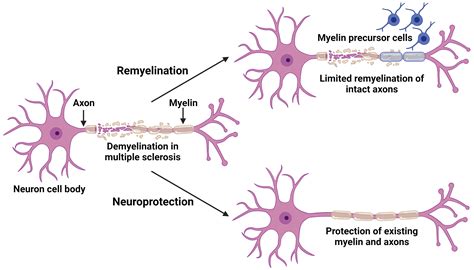 Multiple Sclerosis Neuron