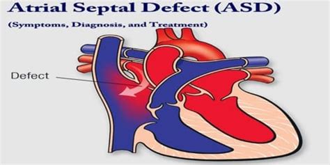 Atrial septal defect (Symptoms, Diagnosis, and Treatment) - Assignment ...