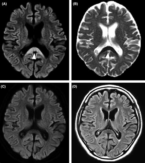 (A and B); MRI studies at onset. Diffusion‐weighted images (DWI) show... | Download Scientific ...