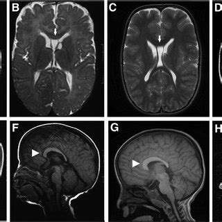 Brain MRI Findings Persistent cavum septum pellucidum (arrows) and ...