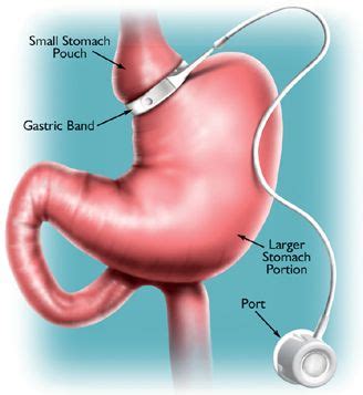 GASTRIC BANDING: About Gastric Banding | Bariatric Surgery | Weight Loss Surgery