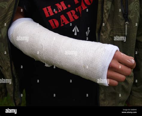 Temporary cast on a fractured wrist, UK 2013 Stock Photo - Alamy