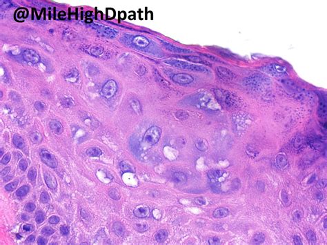 Epidermodysplasia Verruciformis Histology