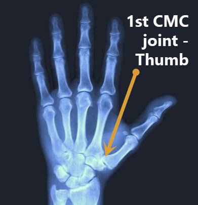 Hand CMC Arthritis - JOI Jacksonville Orthopaedic Institute