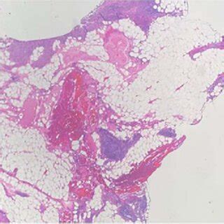 Multiple nodules of hypercellular parathyroid tissue within... | Download Scientific Diagram