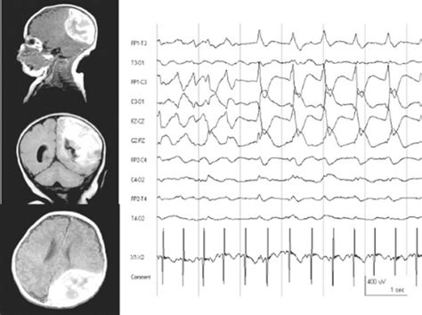 Neonatal Seizures | Obgyn Key