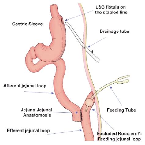 The anatomy before LRYFJ. The LSG leak or fistula is efficiently driven ...