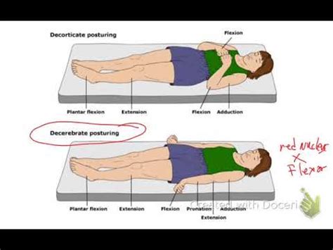 Decerebrate Vs Decorticate Posturing - YouTube