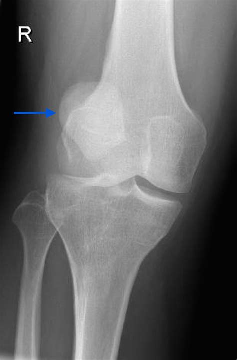 Cureus | Magnetic Resonance Imaging Features of Traumatic Patellofemoral Dislocation