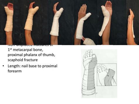 Proximal radial head fracture splint - keryrobo