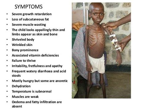 1.malnutrition