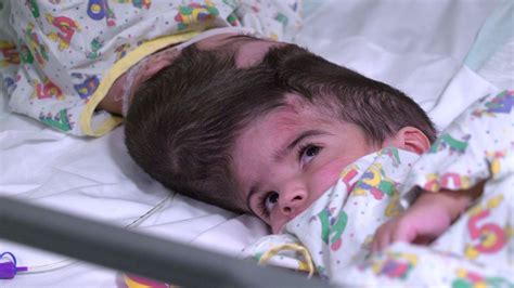 Twins conjoined by skulls separated after 50 hours of operations | UK ...