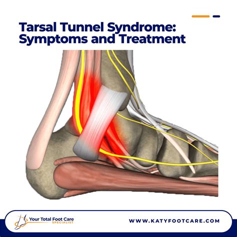 Tarsal Tunnel Syndrome: Symptoms and Treatment