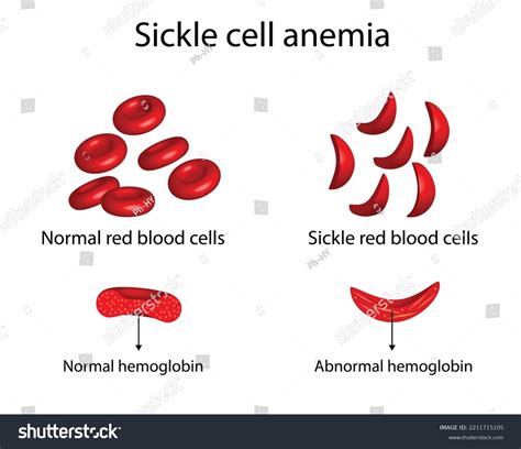 Anemia Normal Red Blood Cell Sickle Stock Vector (Royalty Free) 2211715105 | Shutterstock