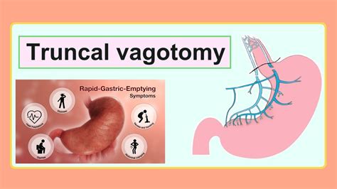 truncal vagotomy - YouTube