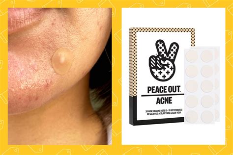 The 13 Best Pimple Patches of 2024