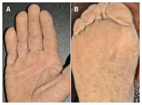 Tripe Palm And Acanthosis Nigricans- Diagnosis? - MEDizzy Journal