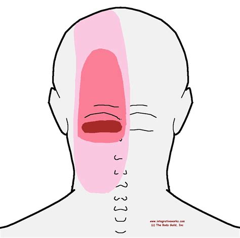 Trigger Points - Headache at the Back of Your Head | Integrative Works