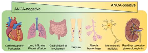 JCM | Free Full-Text | Eosinophilic Granulomatosis with Polyangiitis: Latest Findings and ...