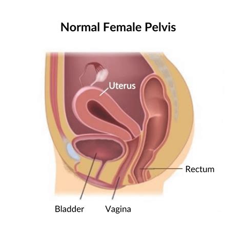 Identifying and Treating Pelvic Organ Prolapse