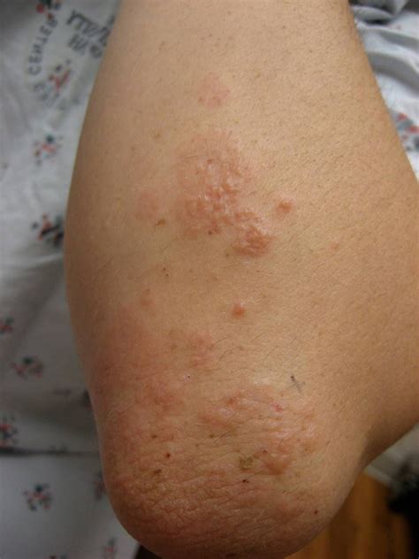 Dermatitis Herpetiformis (Duhring disease) - The Clinical Advisor