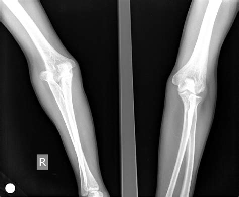 X-ray of the patient showing radial head dislocation. | Download Scientific Diagram