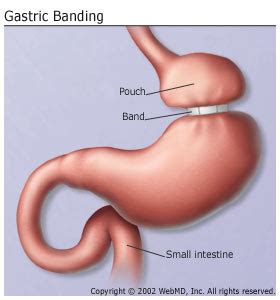 Weight Loss Update: FDA Panel Recommends Making Lap-Band Surgery Available to 12 Million More People