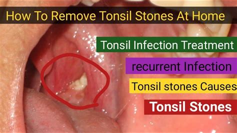 Tonsil stones removal l Wrost Tonsil stones removal l Big Tonsil Stones ...