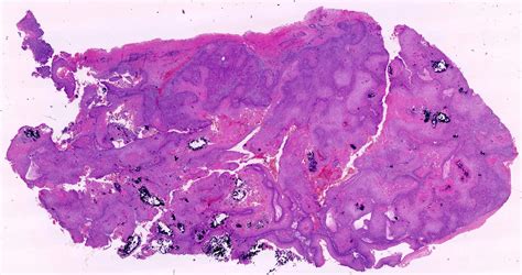 Proliferating Pilar Cyst