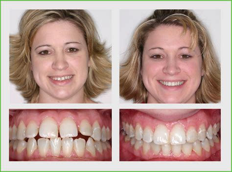 Invisalign Before and After – Orlando, FL