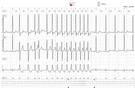 Ventricular Tachycardia Ecg