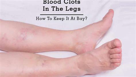 blood clot in leg - blood clot in legblood clot in legblood clot in leg